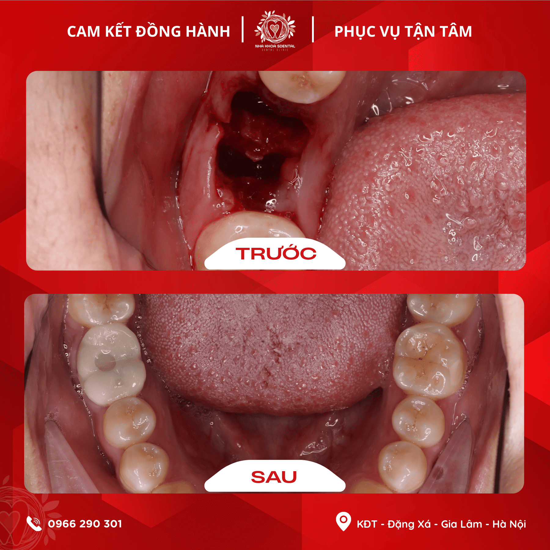Trồng Răng Implant: Câu Chuyện Lấy Lại Nụ Cười Của Chị Nguyễn Thị Hoa Tại S-Dental